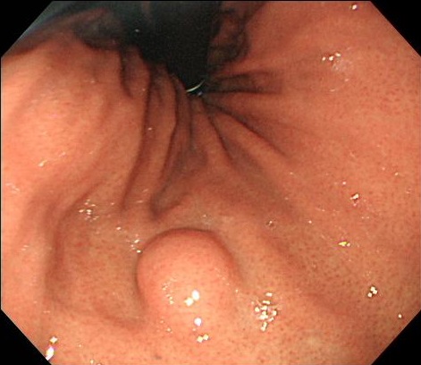 胃粘膜下腫瘍
