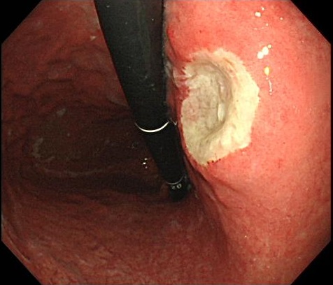 胃十二指腸潰瘍の胃潰瘍
