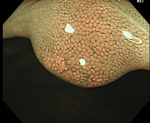 直腸カルチノイド (2)