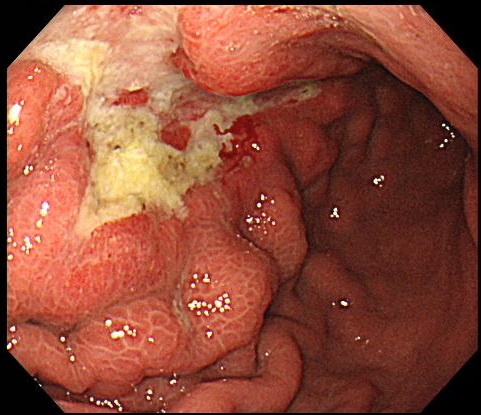 画像進行胃がん